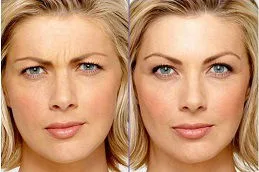 Wrinkle reduction with Botox