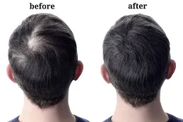 alopecia areata medication