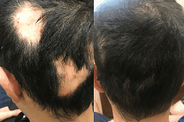 alopecia areata treatment