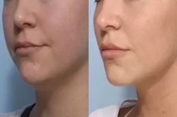 double chin removal before and after