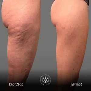 Lymphatic Drainage Before And After Legs