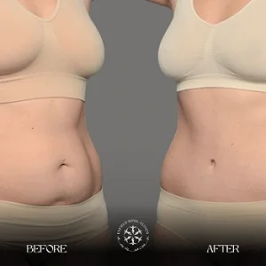 abdominoplasty before and after