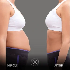 abdominoplasty before and after results