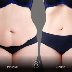 tummy tuck before and after