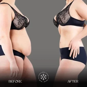 tummy tuck before and after RESULTS