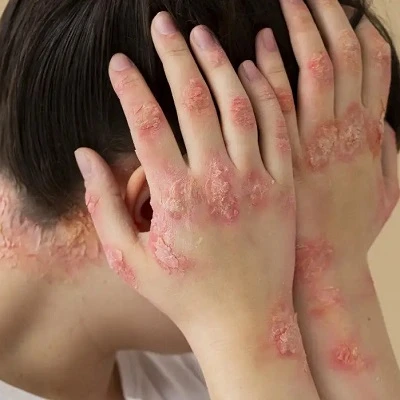 glutathione for eczema Treatment in Riyadh The Best Peptides for Content_Opt_26_05 Size:12g (Travel Size)