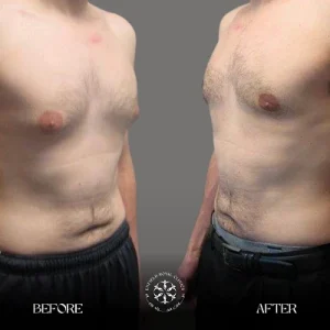 before after gynecomastia