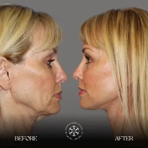 endolift before after