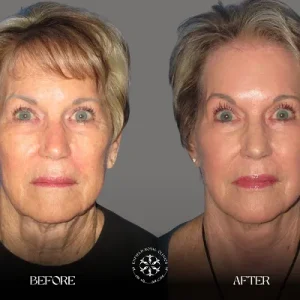 endolift before and after