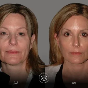 endolift laser before and after
