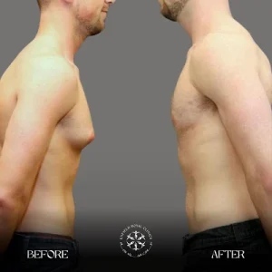 gynecomastia before after