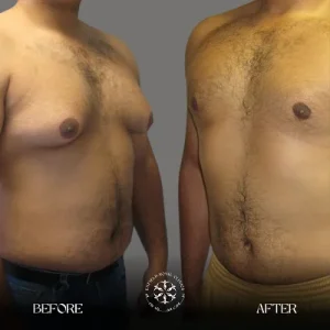 gynecomastia before and after