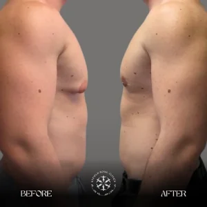 gynecomastia before and after weight loss