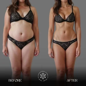 liposuction after and before