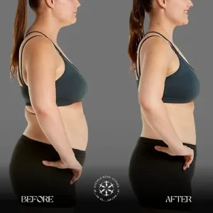 liposuction before and after pics