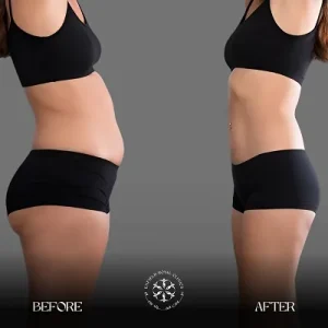 liposuction belly fat before after
